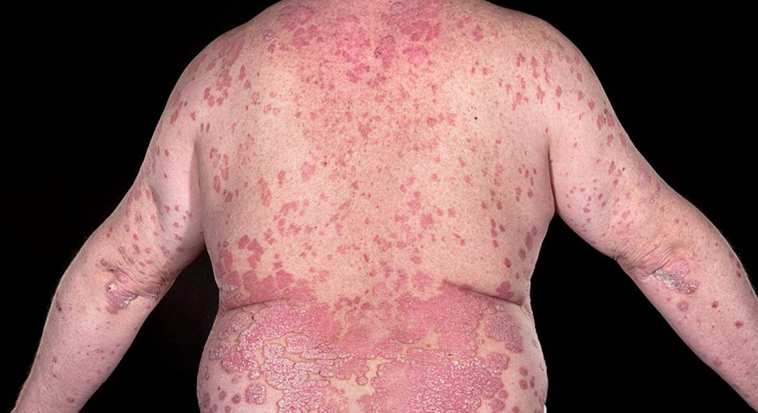 psoriasis